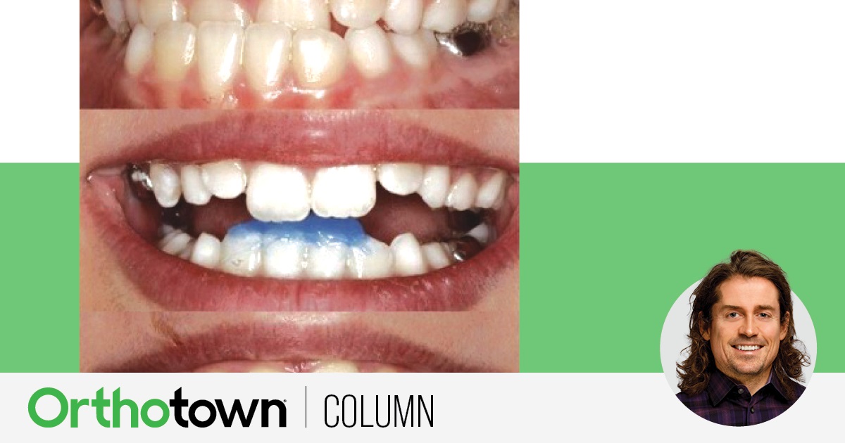 A Voice in the Arena: Bite Ramps, Part 2: Class 3 Bite Ramps Orthotown Editorial Director Dr. Chad Foster has found that shaping bite turbos can be an opportunity to inexpensively, efficiently and creatively redirect the
force of the bite in many cases.